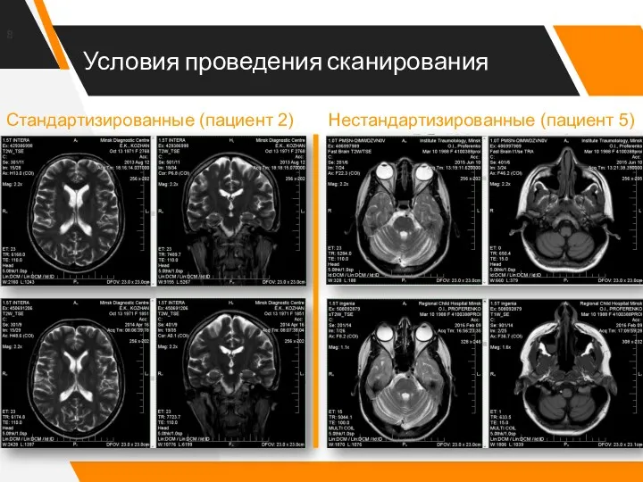 Условия проведения сканирования Стандартизированные (пациент 2) Нестандартизированные (пациент 5)