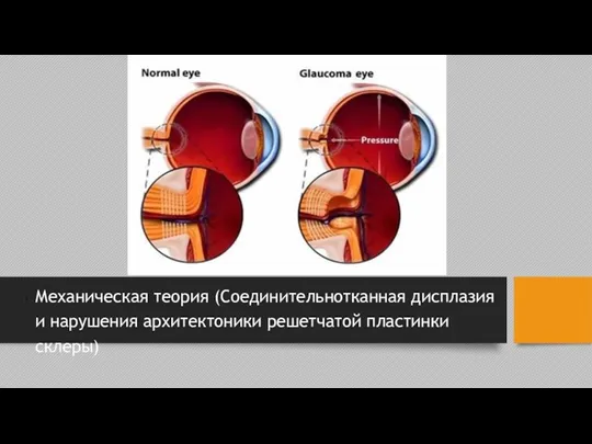 Механическая теория (Соединительнотканная дисплазия и нарушения архитектоники решетчатой пластинки склеры)