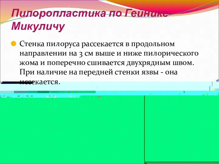 Пилоропластика по Гейнике-Микуличу Стенка пилоруса рассекается в продольном направлении на