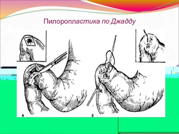 Пилоропластика по Джадду