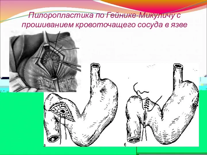 Пилоропластика по Гейнике-Микуличу с прошиванием кровоточащего сосуда в язве