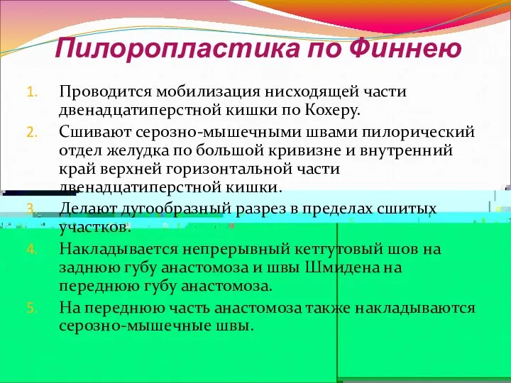 Пилоропластика по Финнею Проводится мобилизация нисходящей части двенадцатиперстной кишки по