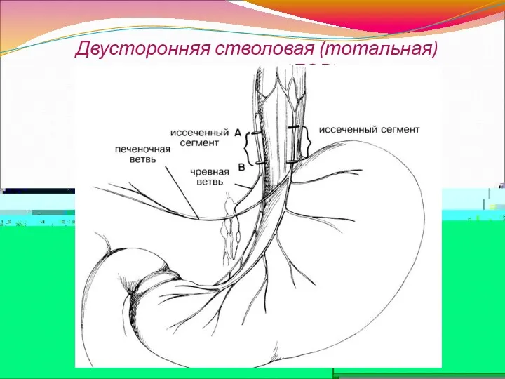 Двусторонняя стволовая (тотальная) ваготомия (ДСВ)