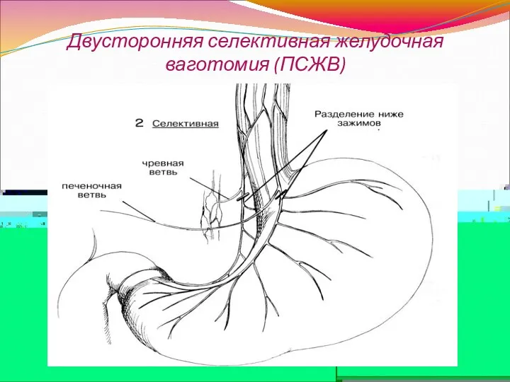 Двусторонняя селективная желудочная ваготомия (ПСЖВ)