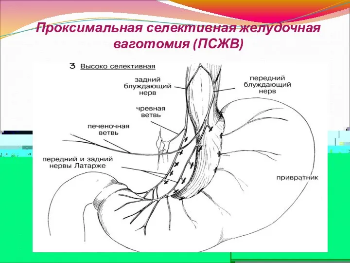 Проксимальная селективная желудочная ваготомия (ПСЖВ)