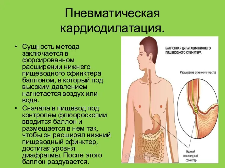 Пневматическая кардиодилатация. Сущность метода заключается в форсированном расширении нижнего пищеводного