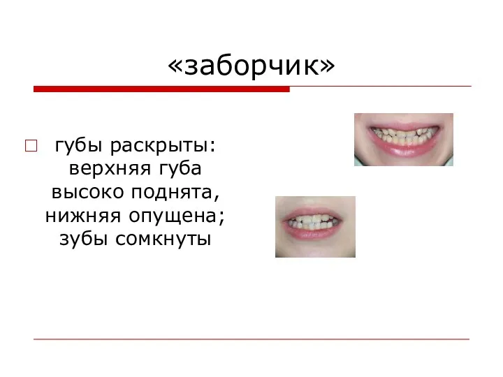 «заборчик» губы раскрыты: верхняя губа высоко поднята, нижняя опущена; зубы сомкнуты
