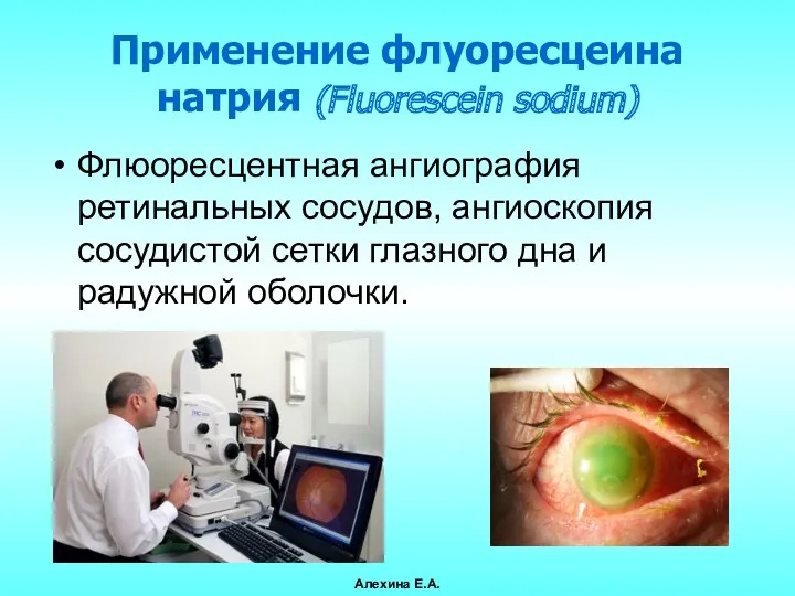 Применение флуоресцеина натрия (Fluorescein sodium) Флюоресцентная ангиография ретинальных сосудов, ангиоскопия