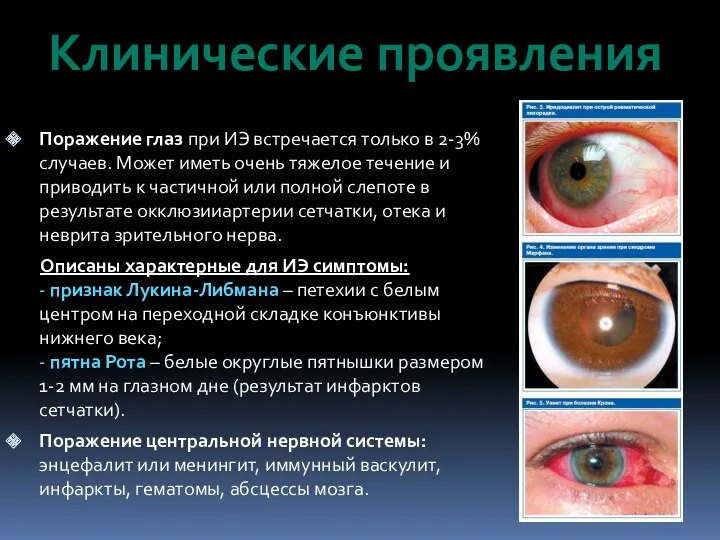 Поражение глаз при ИЭ встречается только в 2-3% случаев. Может иметь очень тяжелое