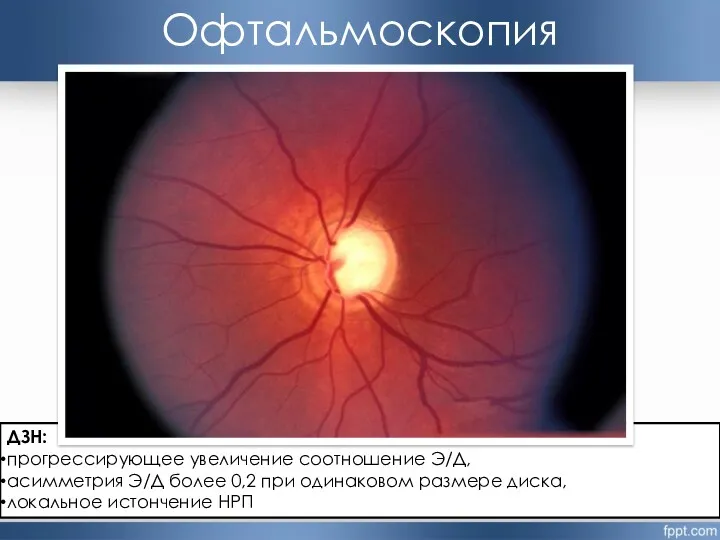 Офтальмоскопия ДЗН: прогрессирующее увеличение соотношение Э/Д, асимметрия Э/Д более 0,2