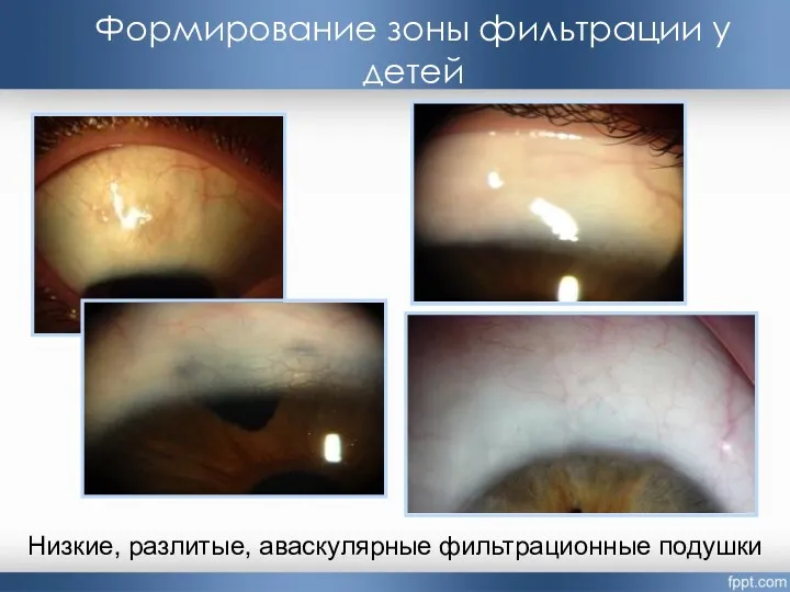 Формирование зоны фильтрации у детей Низкие, разлитые, аваскулярные фильтрационные подушки
