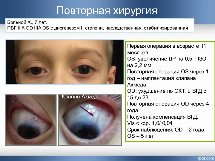 Повторная хирургия Первая операция в возрасте 11 месяцев OS: увеличение