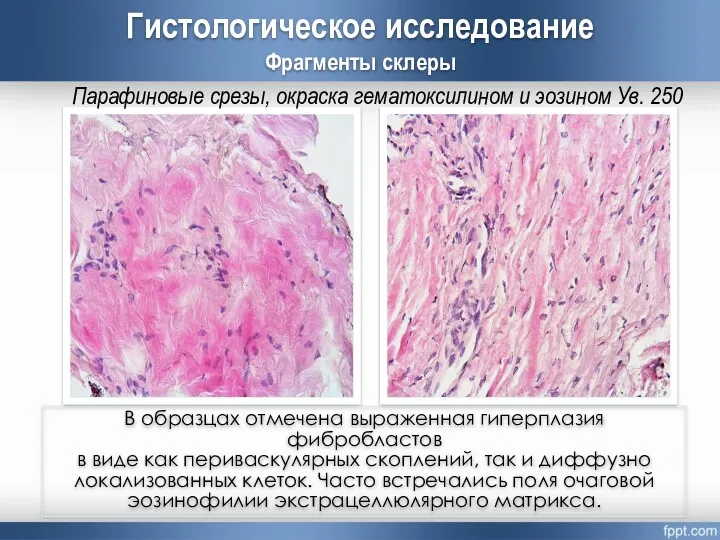 Гистологическое исследование Фрагменты склеры Парафиновые срезы, окраска гематоксилином и эозином