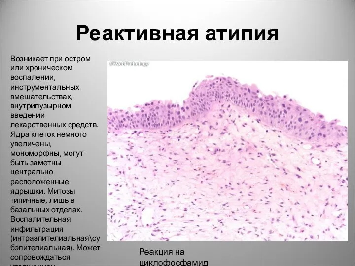 Реактивная атипия Возникает при остром или хроническом воспалении, инструментальных вмешательствах,