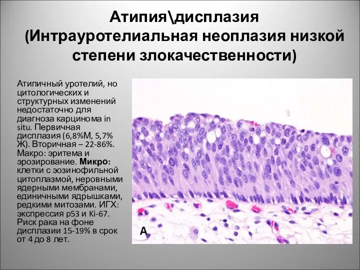 Атипия\дисплазия (Интрауротелиальная неоплазия низкой степени злокачественности) Атипичный уротелий, но цитологических