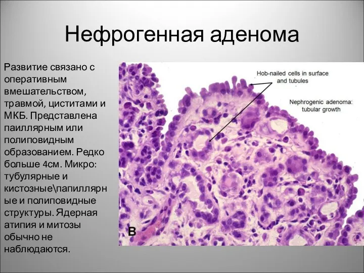 Нефрогенная аденома Развитие связано с оперативным вмешательством, травмой, циститами и