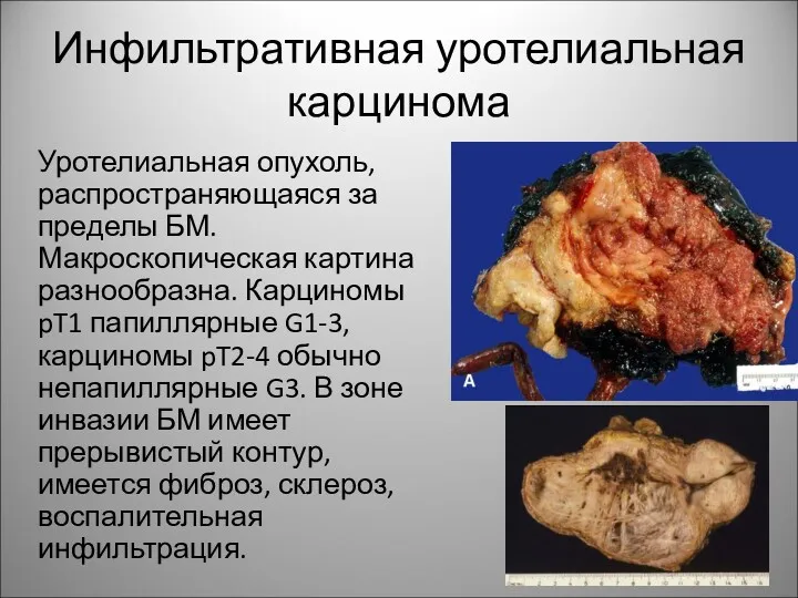 Инфильтративная уротелиальная карцинома Уротелиальная опухоль, распространяющаяся за пределы БМ. Макроскопическая