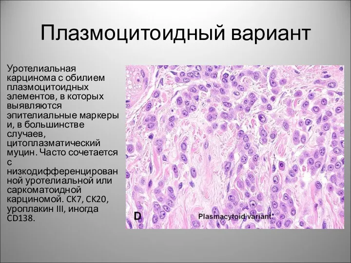 Плазмоцитоидный вариант Уротелиальная карцинома с обилием плазмоцитоидных элементов, в которых