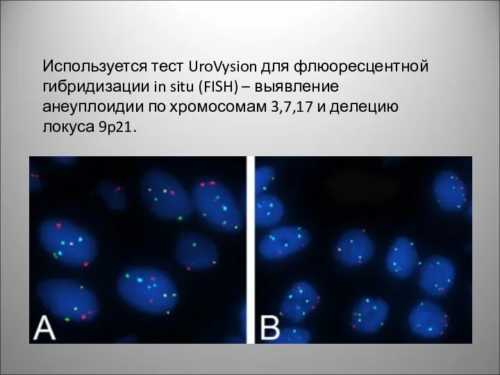 Используется тест UroVysion для флюоресцентной гибридизации in situ (FISH) –