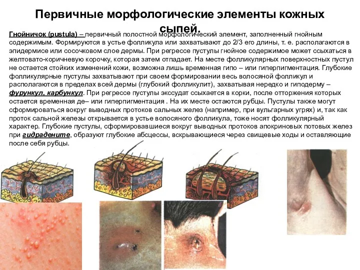 Первичные морфологические элементы кожных сыпей. Гнойничок (pustula) – первичный полостной
