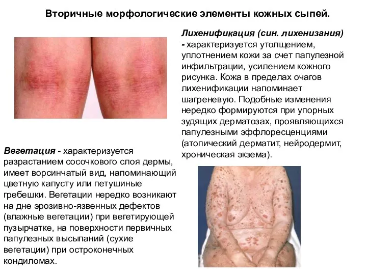 Вторичные морфологические элементы кожных сыпей. Лихенификация (син. лихенизания) - характеризуется