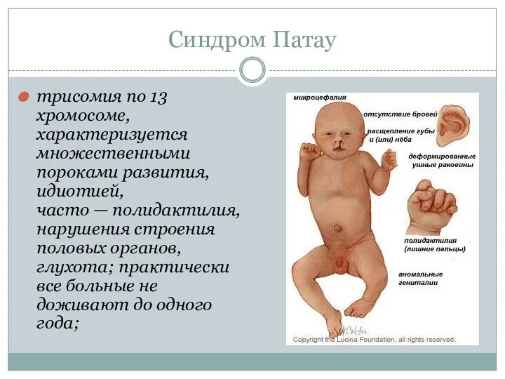 Синдром Патау трисомия по 13 хромосоме, характеризуется множественными пороками развития,