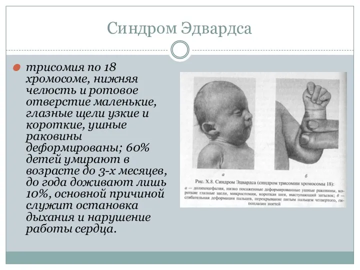 Синдром Эдвардса трисомия по 18 хромосоме, нижняя челюсть и ротовое