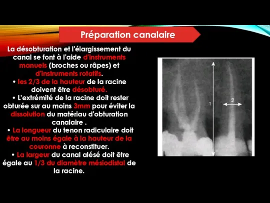 Préparation canalaire La désobturation et l'élargissement du canal se font