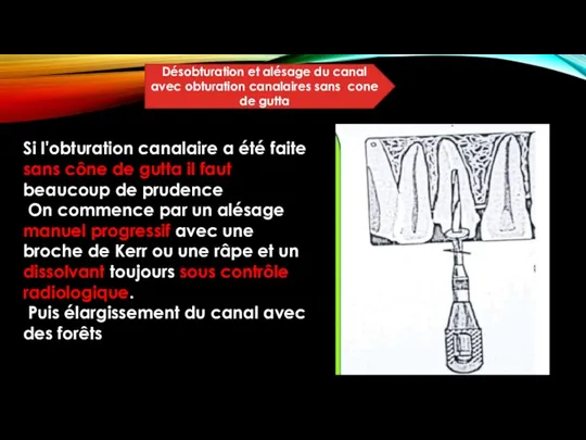 Désobturation et alésage du canal avec obturation canalaires sans cone