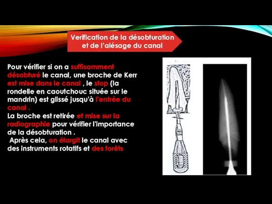 Verification de la désobturation et de l’alésage du canal Pour