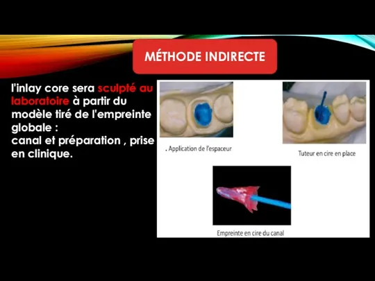 l'inlay core sera sculpté au laboratoire à partir du modèle