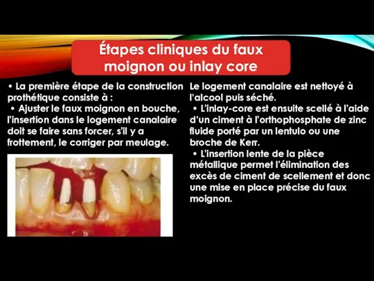 Étapes cliniques du faux moignon ou inlay core • La