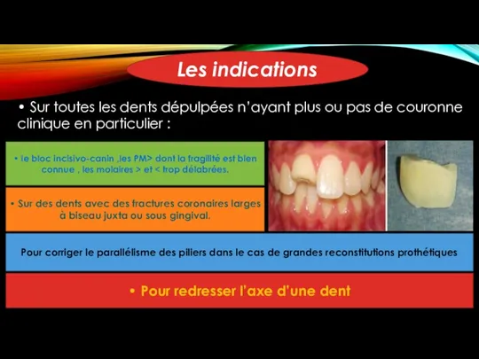 • le bloc incisivo-canin ,les PM> dont la fragilité est