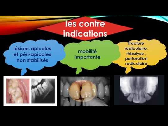 fracture radiculaire, rhizalyse , perforation radiculaire mobilité importante lésions apicales