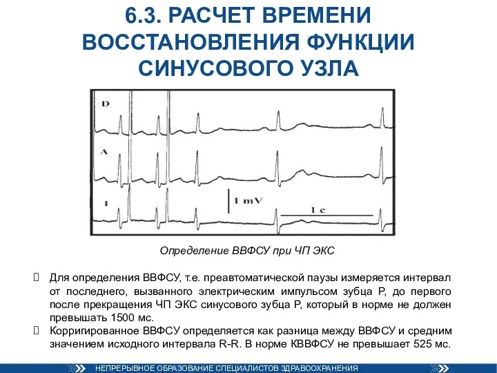 6.3. РАСЧЕТ ВРЕМЕНИ ВОССТАНОВЛЕНИЯ ФУНКЦИИ СИНУСОВОГО УЗЛА Определение ВВФСУ при