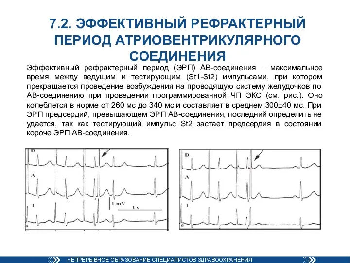 7.2. ЭФФЕКТИВНЫЙ РЕФРАКТЕРНЫЙ ПЕРИОД АТРИОВЕНТРИКУЛЯРНОГО СОЕДИНЕНИЯ Эффективный рефрактерный период (ЭРП)