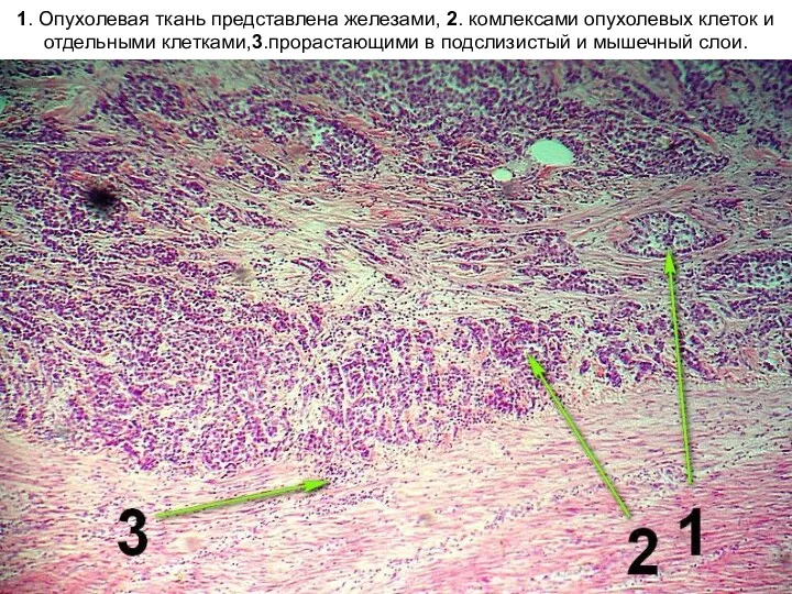 1. Опухолевая ткань представлена железами, 2. комлексами опухолевых клеток и отдельными клетками,3.прорастающими в