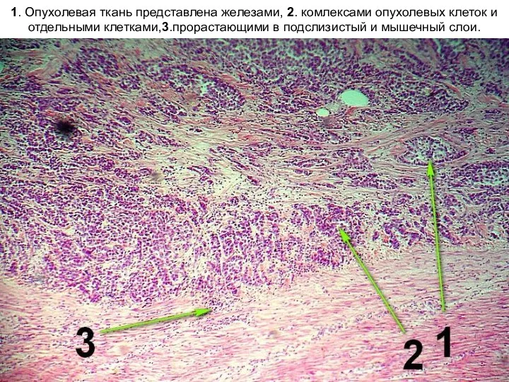 1. Опухолевая ткань представлена железами, 2. комлексами опухолевых клеток и