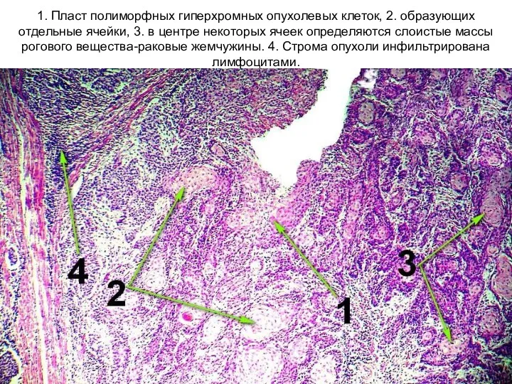 1. Пласт полиморфных гиперхромных опухолевых клеток, 2. образующих отдельные ячейки, 3. в центре