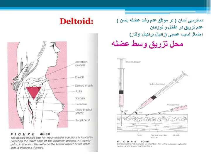 Deltoid: دسترسی آسان ( در مواقع عدم رشد عضله باسن