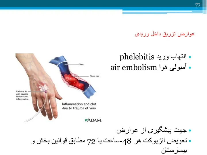 عوارض تزریق داخل وریدی التهاب ورید phelebitis آمبولی هوا air