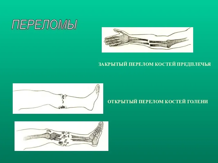 ЗАКРЫТЫЙ ПЕРЕЛОМ КОСТЕЙ ПРЕДПЛЕЧЬЯ ОТКРЫТЫЙ ПЕРЕЛОМ КОСТЕЙ ГОЛЕНИ ПЕРЕЛОМЫ
