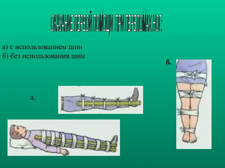 а) с использованием шин б) без использования шин а. б. ОКАЗАНИЕ ПЕРВОЙ ПОМОЩИ ПРИ ПЕРЕЛОМАХ НОГ: