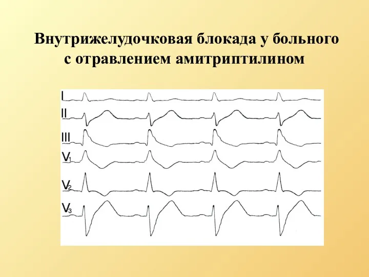 Внутрижелудочковая блокада у больного с отравлением амитриптилином
