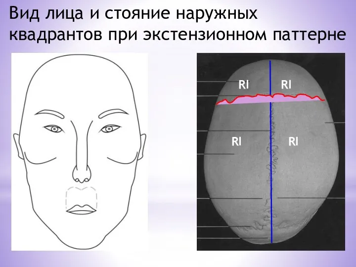 Вид лица и стояние наружных квадрантов при экстензионном паттерне RI RI RI RI