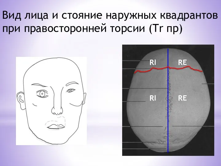 RI RE RI RE Вид лица и стояние наружных квадрантов при правосторонней торсии (Tr пр)