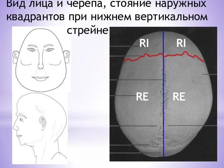 RI RI RE RE Вид лица и черепа, стояние наружных квадрантов при нижнем вертикальном стрейне