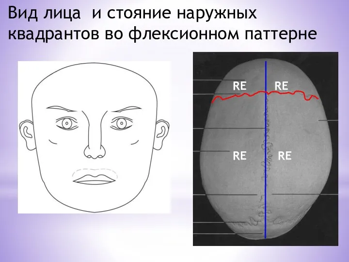 Вид лица и стояние наружных квадрантов во флексионном паттерне RE RE RE RE