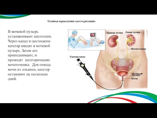 В мочевой пузырь устанавливают цистоскоп. Через канал в цистоскопе катетер