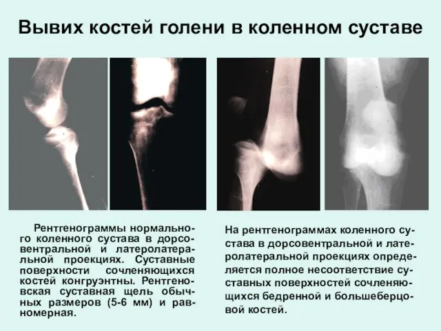 Вывих костей голени в коленном суставе Рентгенограммы нормально-го коленного сустава
